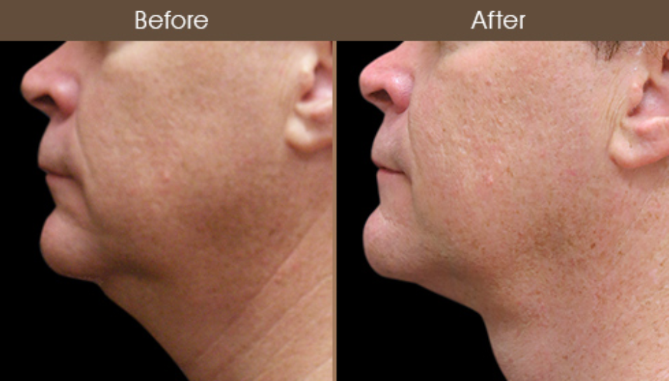Laser Neck Lift Before & After In NYC